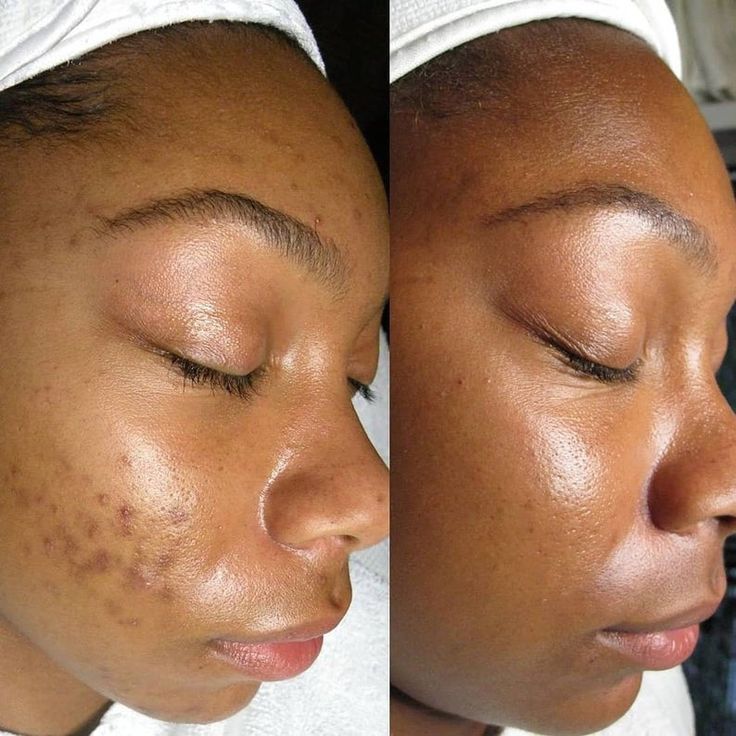 Axis-y Dark Spots Correcting Serum